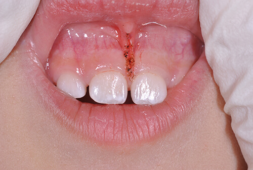 上唇小帯・舌小帯のレーザー切除治療について